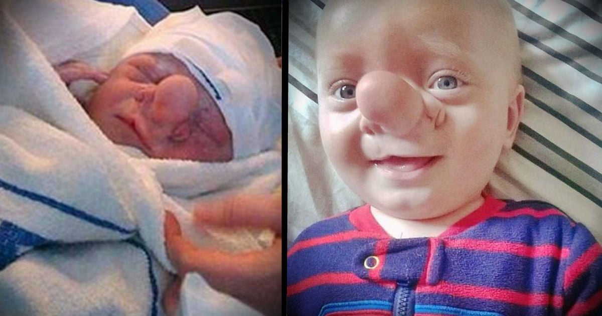 Baby Ollie Born With Part Of His Brain Growing In His Nose