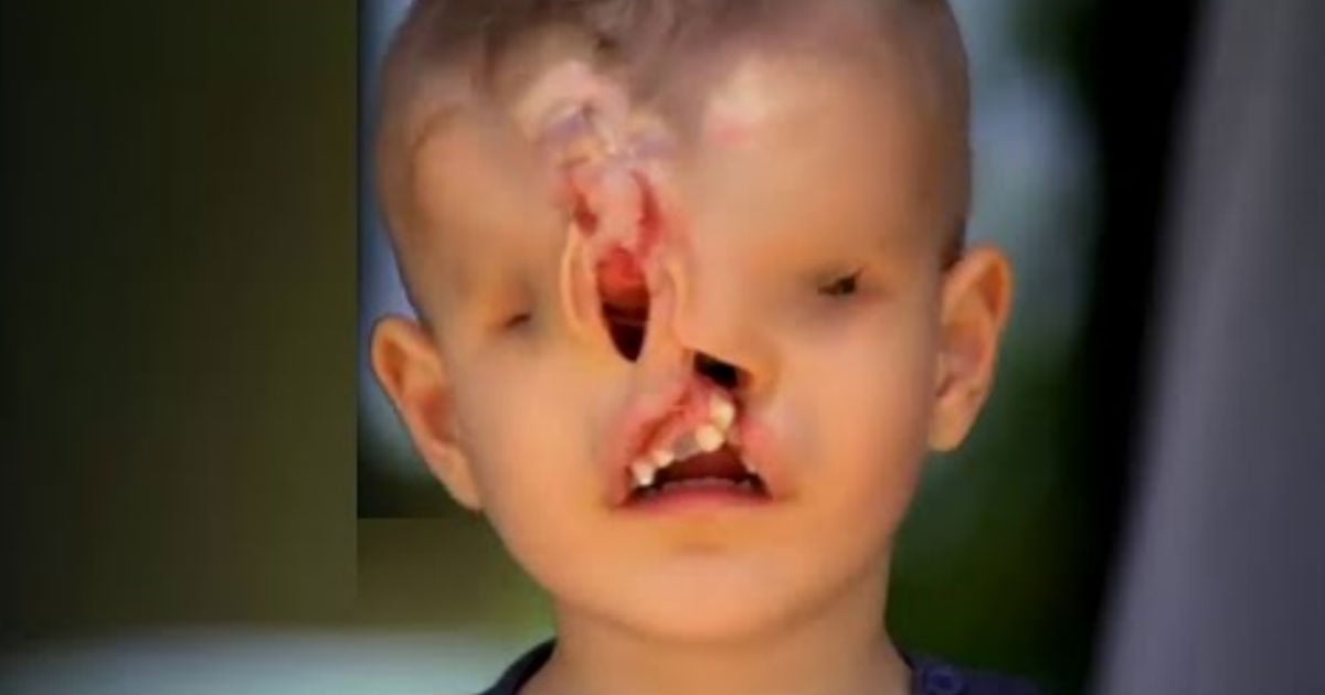 Stranger Funds Surgery For Boy With Deformed Face