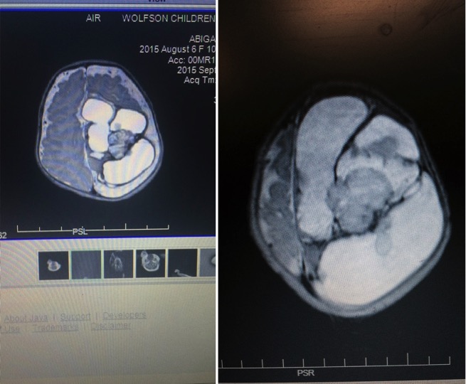 mj-godupdates-baby-with-inoperable-brain-tumor-update-6