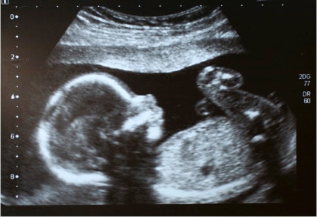 mj-godupdates-mom-sees-ultrasound-and-leaves-abortion-clinic-2