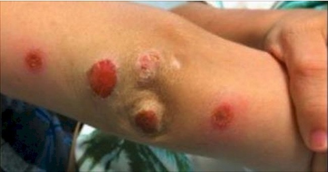 godupdates bounce house staph infection warning 2