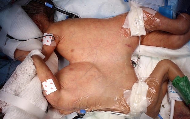 godupdates 8-day-old conjoined twins youngest to survive separation 2