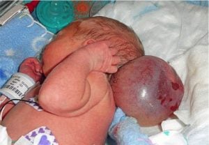 godupdates baby girl born with brain growing out of skull turns 4 1