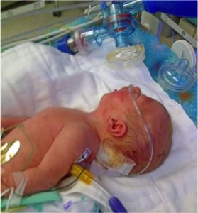 godupdates baby girl born with brain growing out of skull turns 4 2