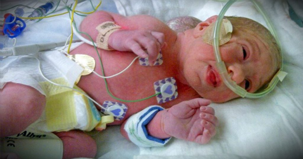 godupdates baby girl born with brain growing out of skull turns 4 fb