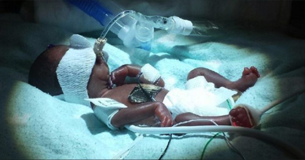 godupdates smallest baby born 14 weeks early 10 ounces goes home fb