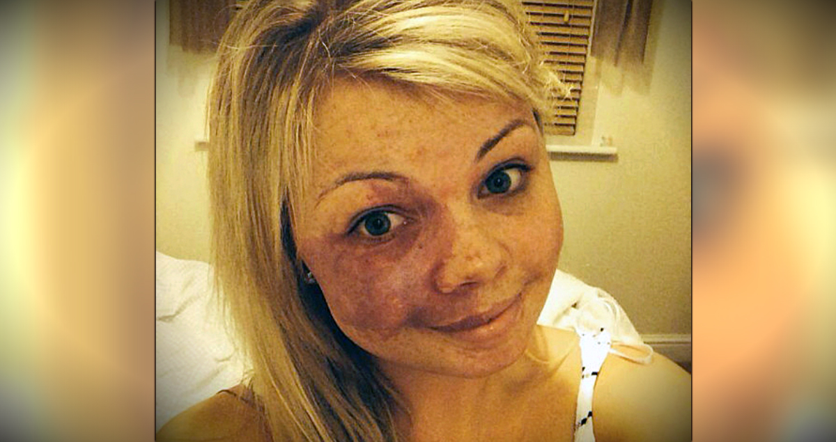 Womans No Make Up Selfie Featuring Her Birthmark Sets Bullies Straight