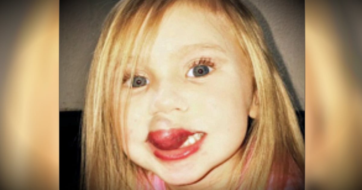 godupdates 3-year-old gets surgery to remove kiwi-sized birthmark on lip fb