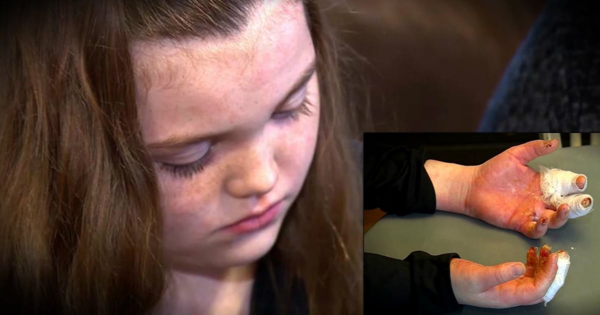 godupdates homemade slime gave third degree burns to little girl fb