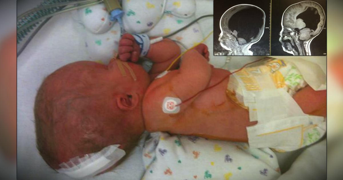 godupdates miracle boy born with virtually no brain recovers fb