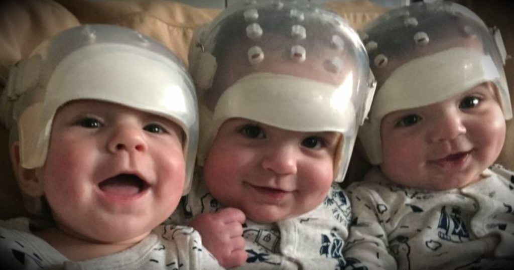 godupdates special triplets share the same rare birth defect make medical history fb