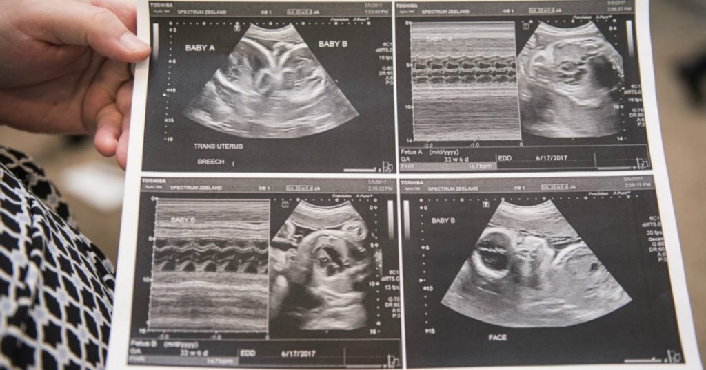 godupdates couple battling infertility conceives 3 sets of twins 2
