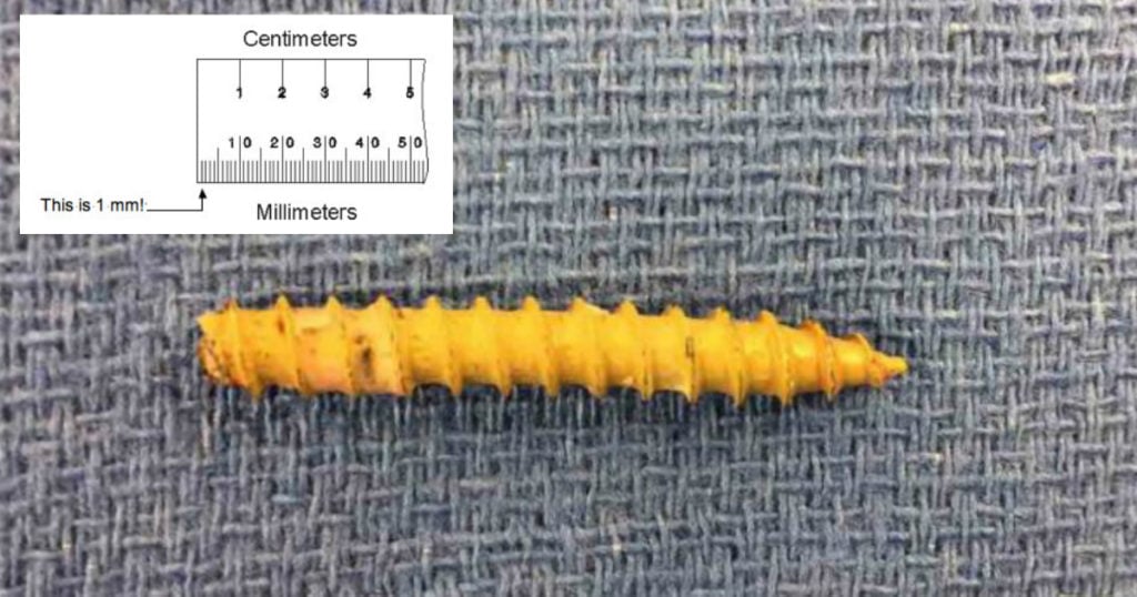 godupdates 6-inch screw pierced a boy's skull bizarre stories 3