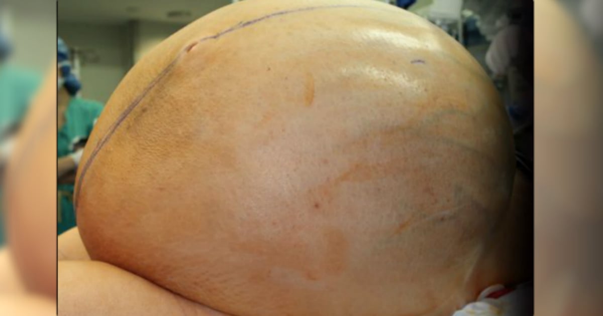 godupdates doctors remove 132-pound tumor from woman's ovary fb