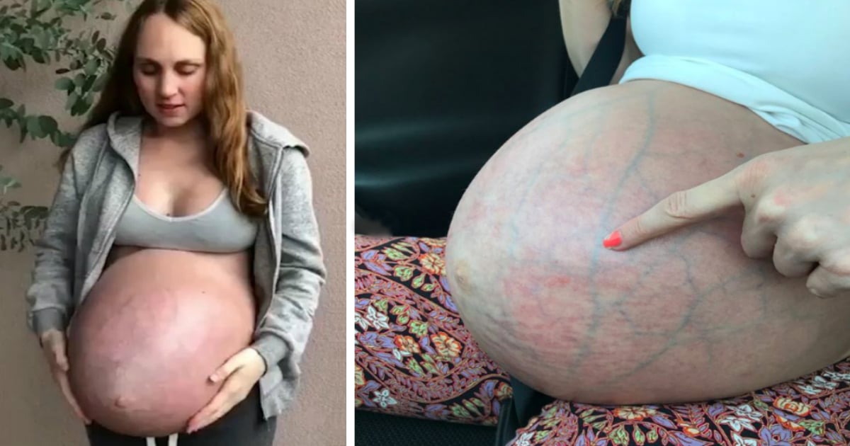 mom expecting triplets opens up about strange bump fb