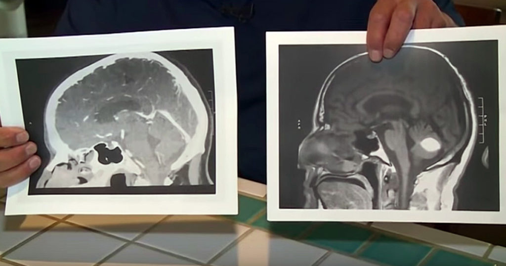 brain tumor vanished medical miracle_FB