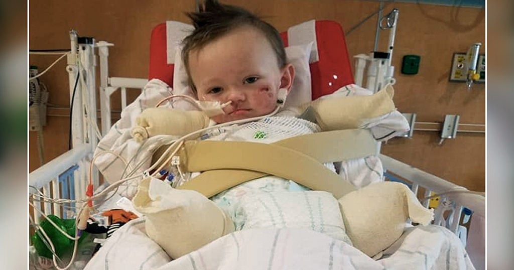 toddler's amputation from mystery illness jeremiah cox