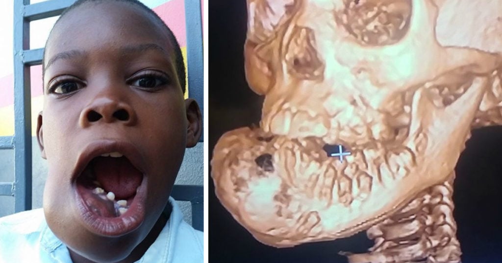 boy with a facial tumor little john miraculous healing