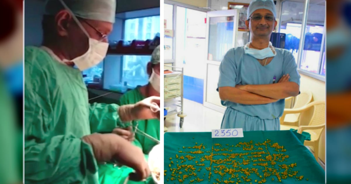 2350 gallstones removed 50-year-old woman