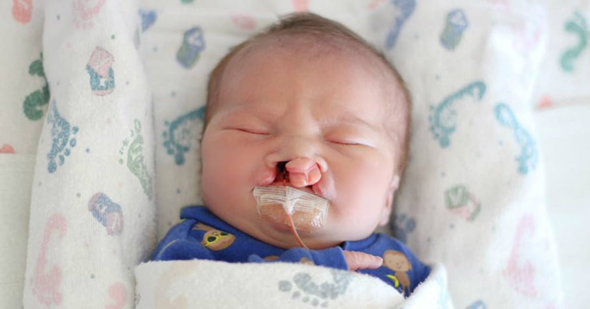 baby born with severe cleft palate act of kindness