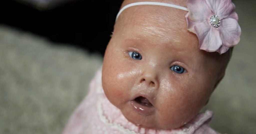 Do Babies with Harlequinn Ichthyosis Survive? Blessed by ...