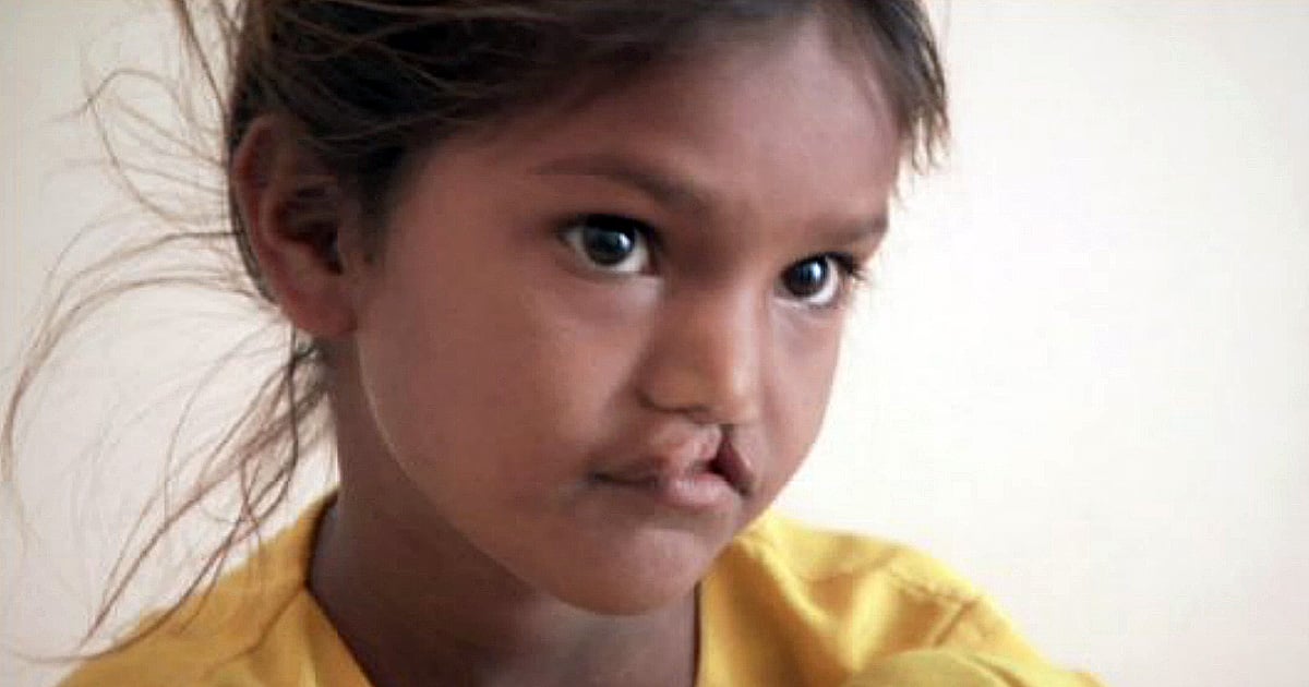free cleft lip surgery smile pinki short inspirational story