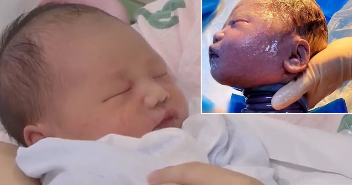 umbilical cord wrapped around neck 6 times
