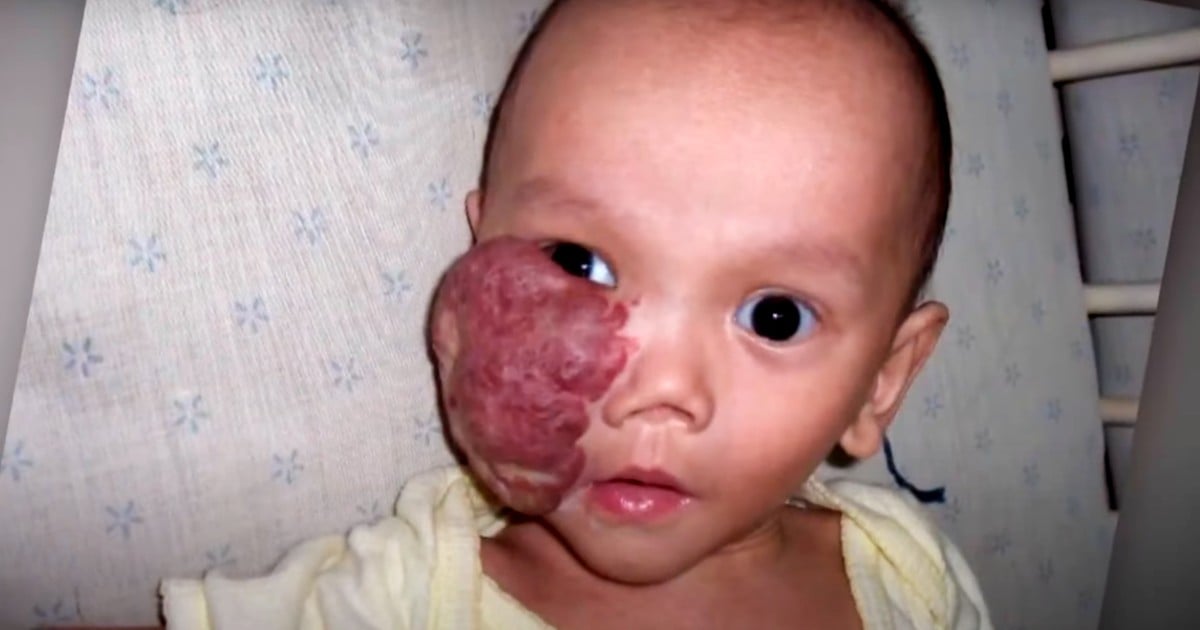baby with facial tumor sam ettore