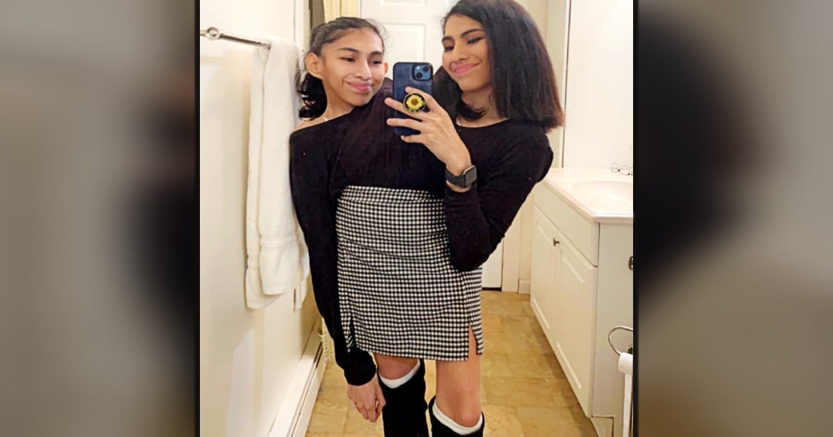 adult conjoined twins Lupita and Carmen Andrade