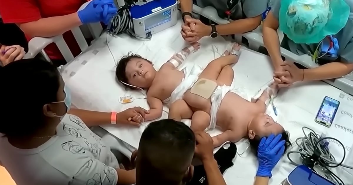 Conjoined Twins Separated in Houston, Texas