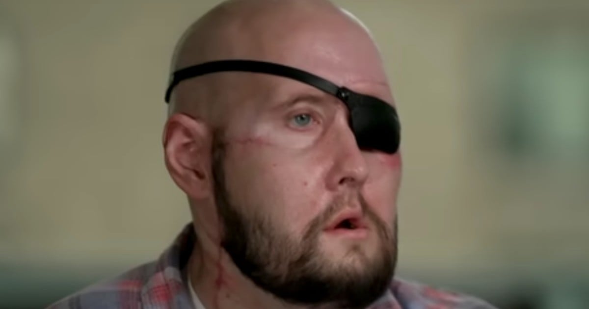 a lineman received a face transplant after electrocution
