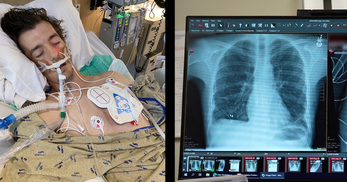 double lung transplant operation